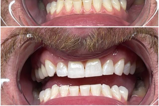 Teeth Whitening