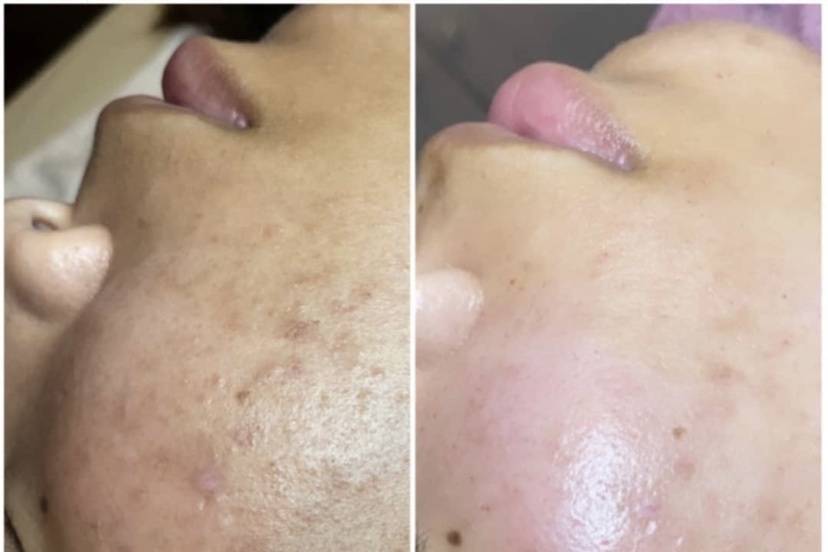Microneedling acne revision