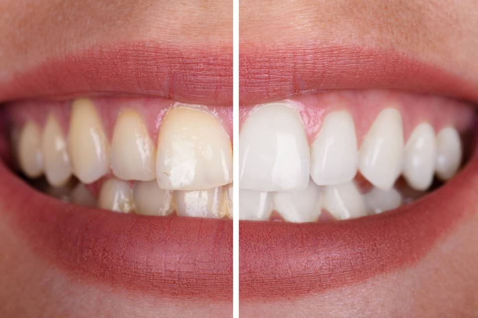 Before and After Whitening