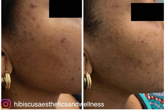 Dark spot treatment