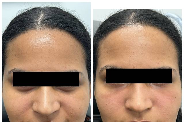 Undereye PRF treatment