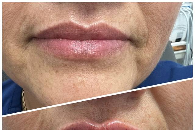 Lip filler