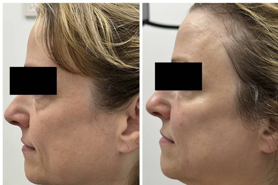 Facial Rejuvenation with PRF