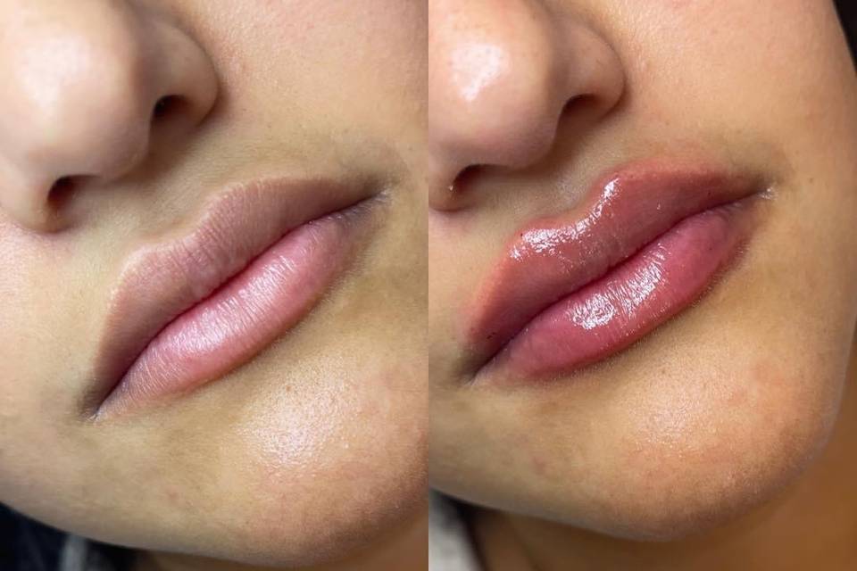 Before and After Lips