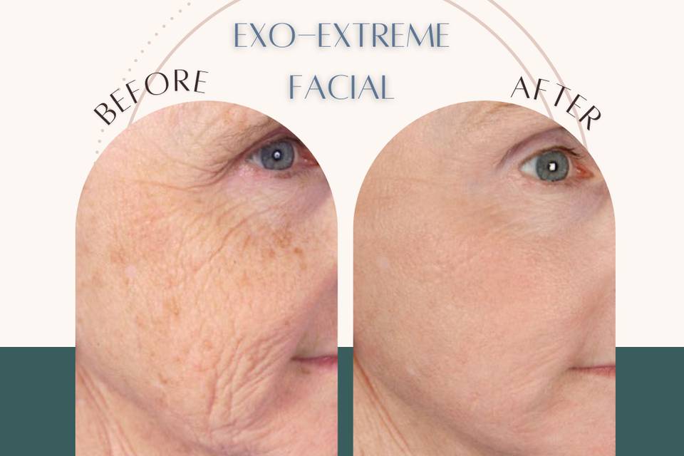 Opus Exo-Extreme Facial