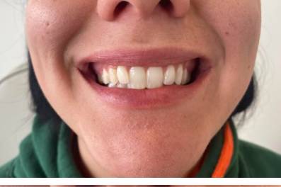 Before and After Lip Filler