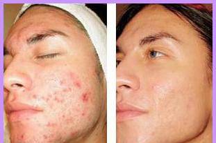 Acne Treatments