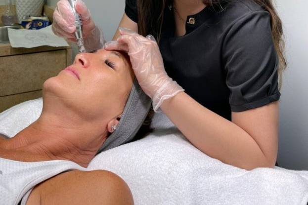 Microneedling