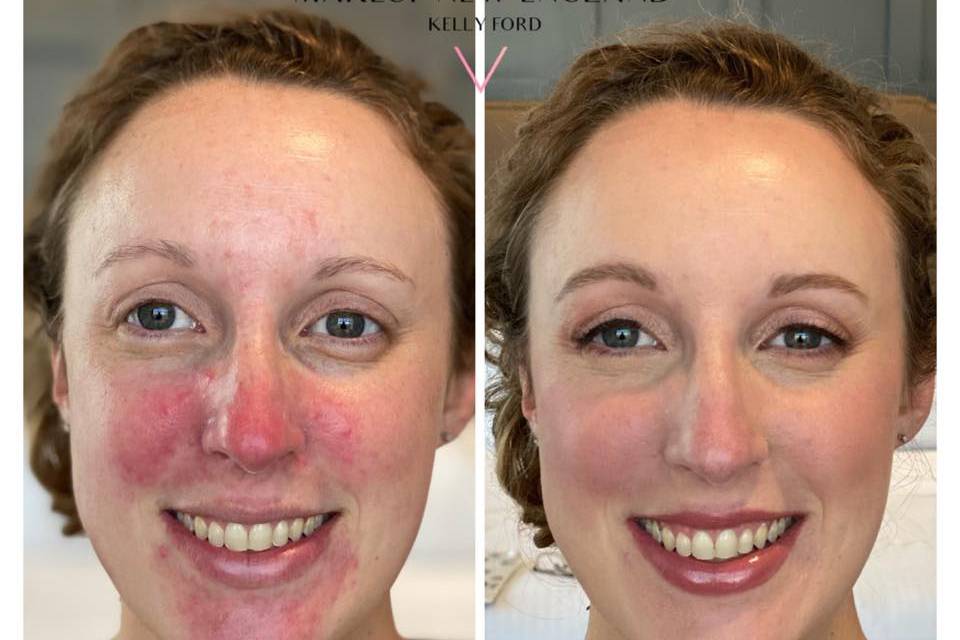 Rosacea?  No Problem!