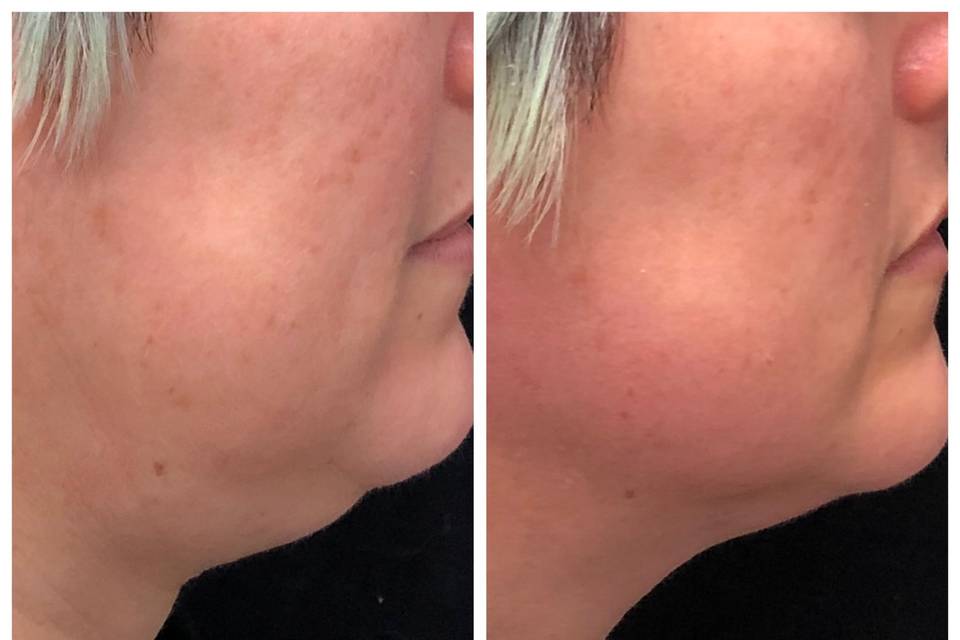 Laser Skin Tightening