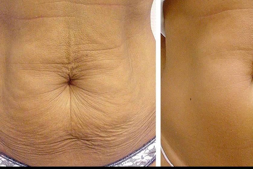 Laser Skin Tightening