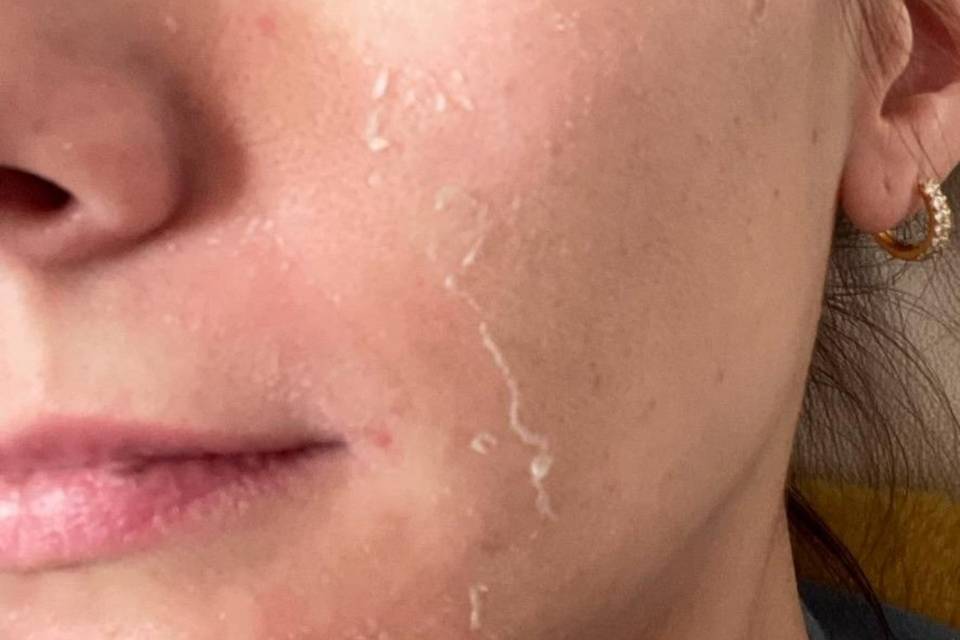 Chemical Peel - 5 days post