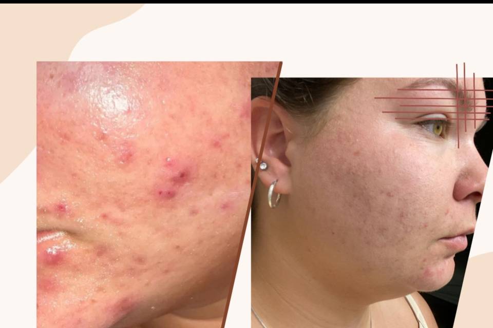1 Year acne difference