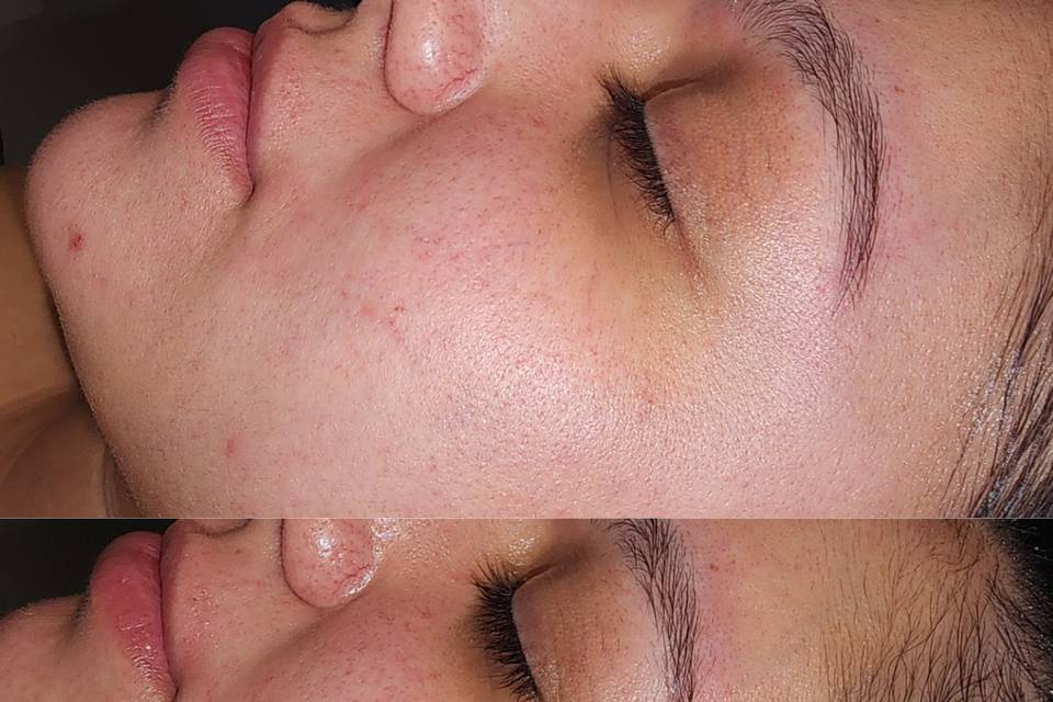 Before / After Glam Glo2Facial