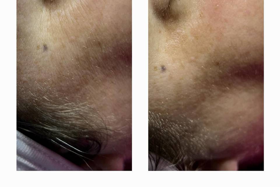 Before and after double peel facial with lymphatic drainage