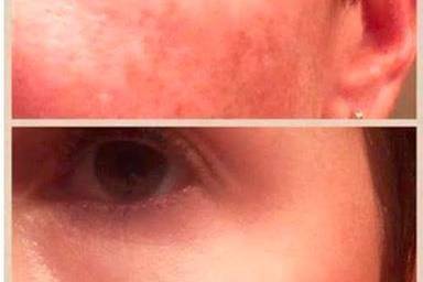 We can even out skin tone so you can have a beautiful, radiant complexion and go foundation free!
