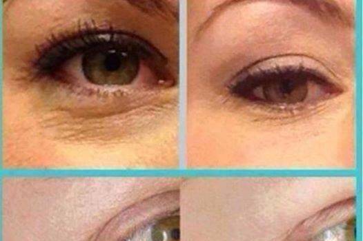 We can reduce crows feet and dark circles under your eyes!