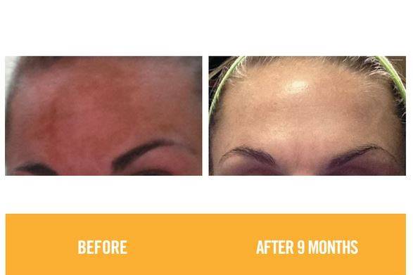 Do you have dark spots from sun exposure? We can clear those up!