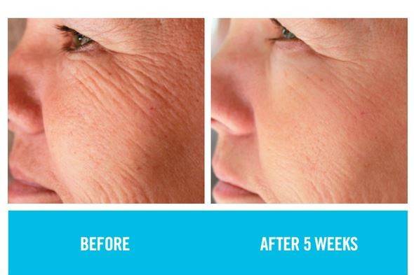 Wrinkles, be gone!!