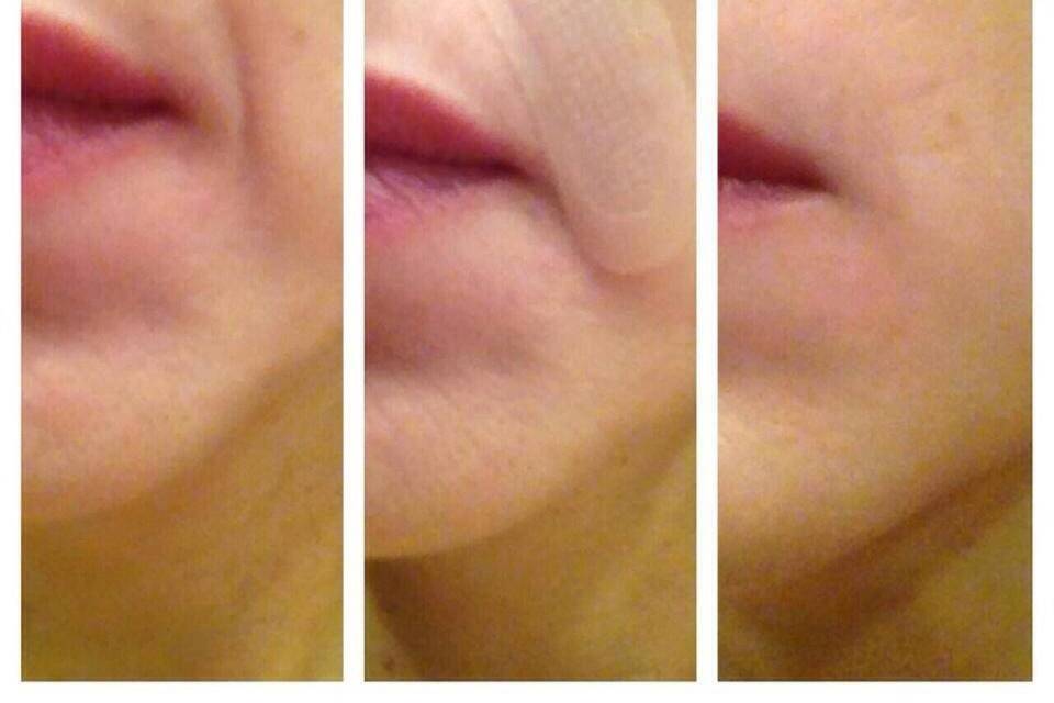 My filler patches really work!! No needle required!