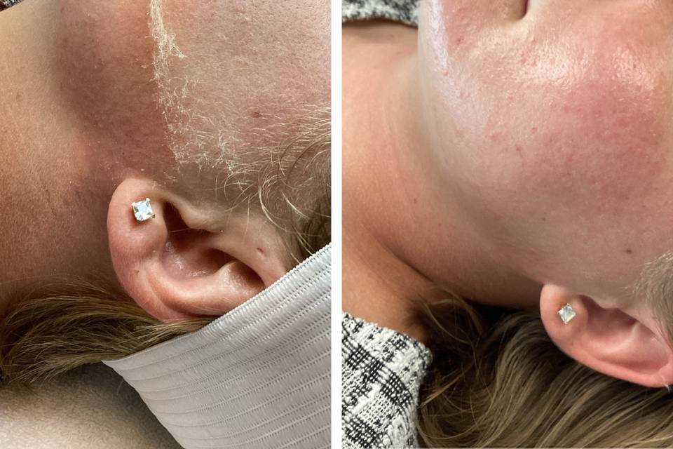 Before and after dermaplane facial