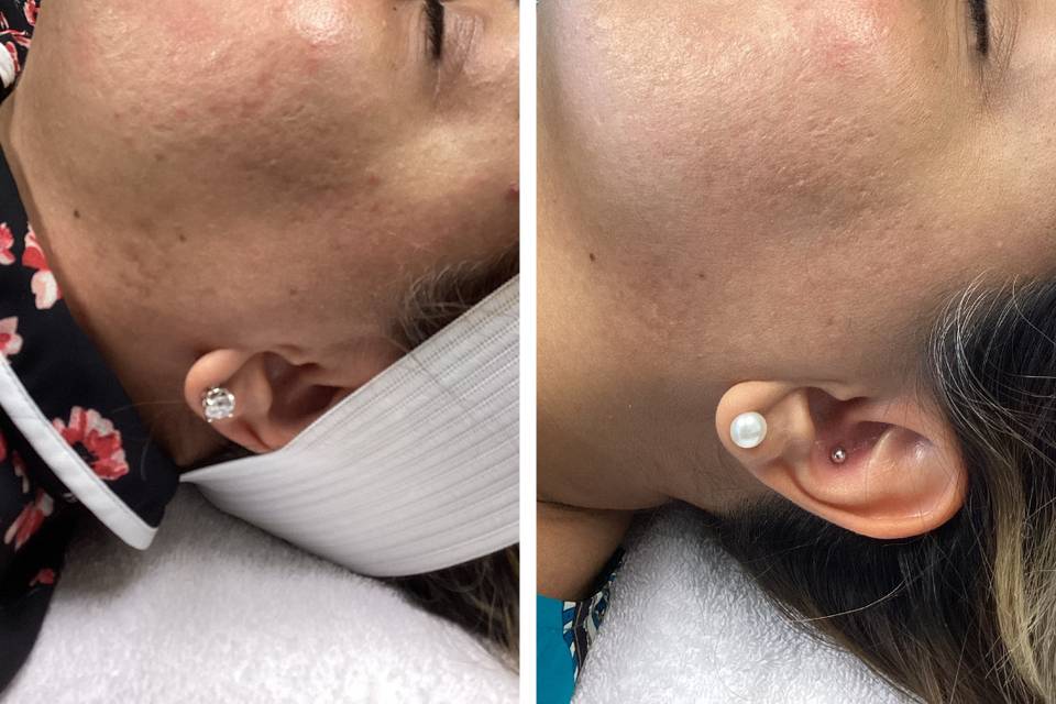 Before and after microneedling