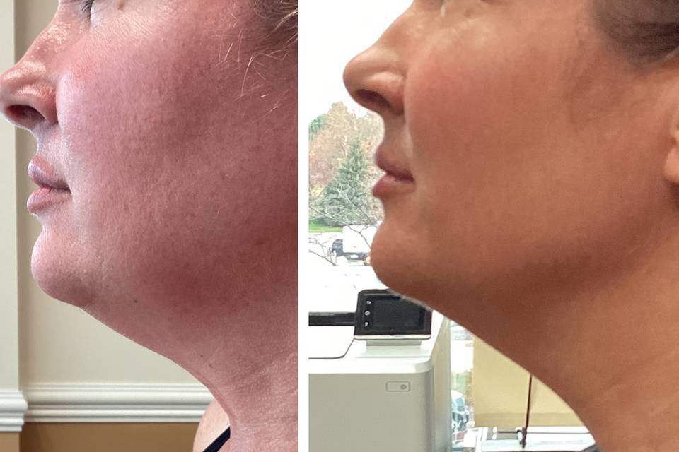 Before and After TruSculpt