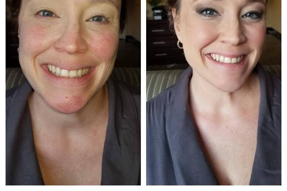 Before and After Rosacea