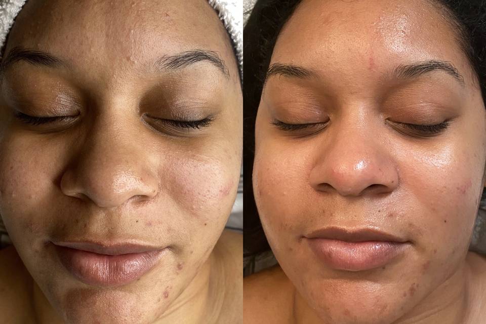 Before and after facial