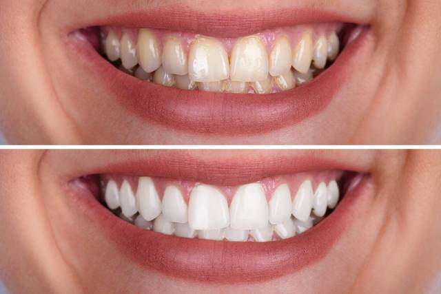 Before after whitenning