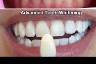 Advanced teeth whitenning