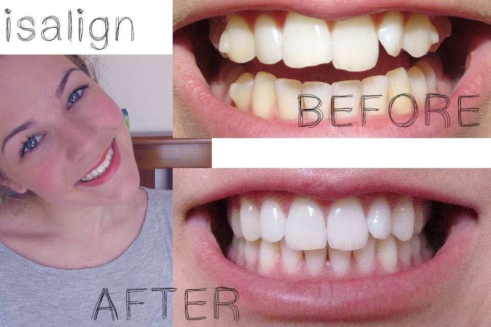 Smile makeovers