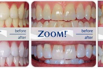 Zoom Whitenning Before/After
