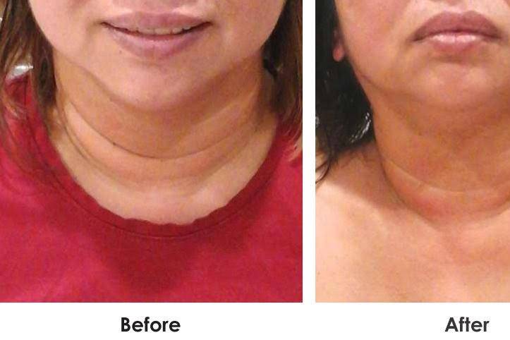 Neck Treatment Single Session