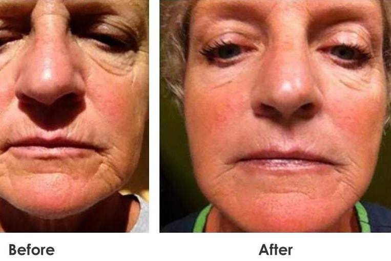 Before & After