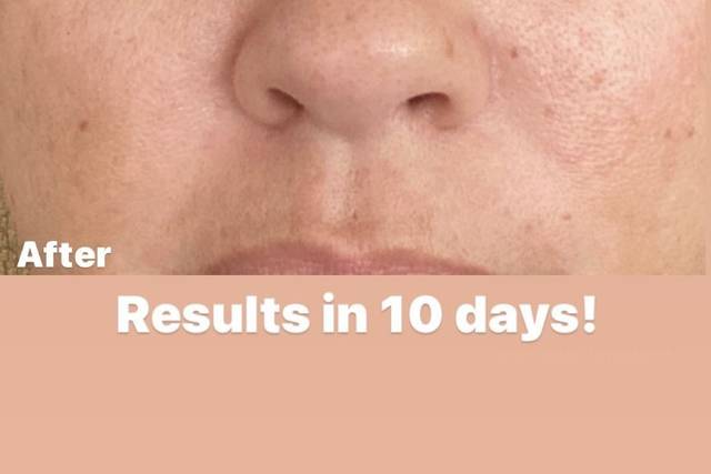 B/A for hyperpigmentation