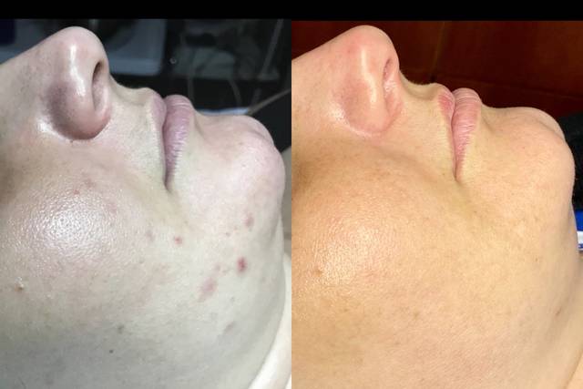 B/A or Acne (PIH)