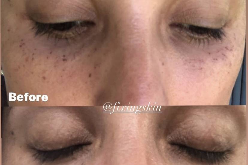 B/A hyperpigmentation