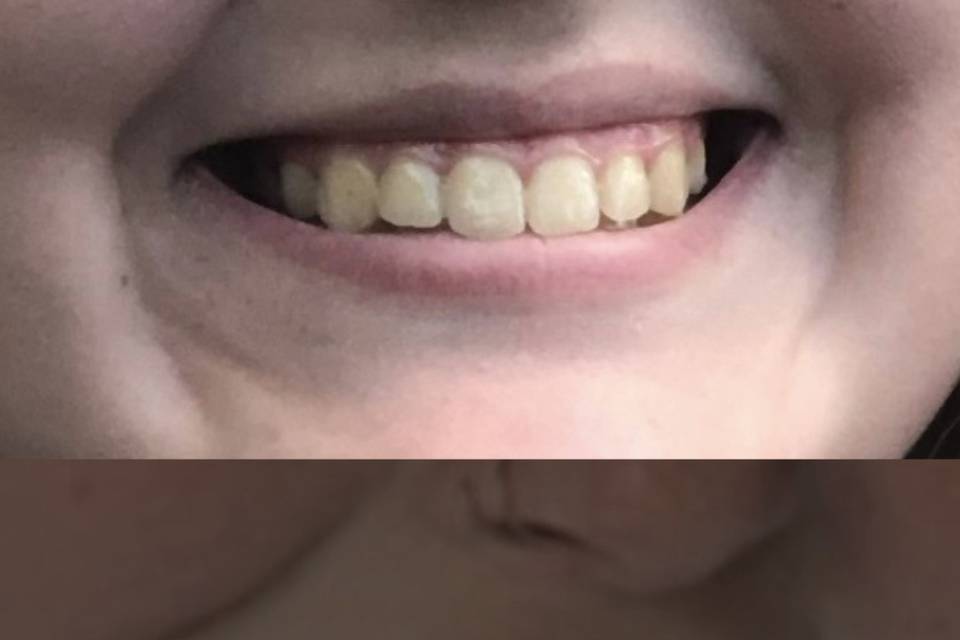 Lip filler before and after