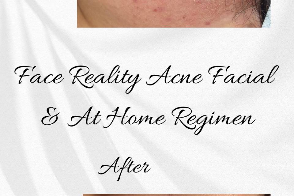 Results of Acne bootcamp