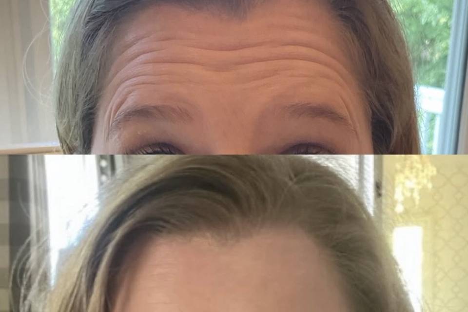 Crows feet