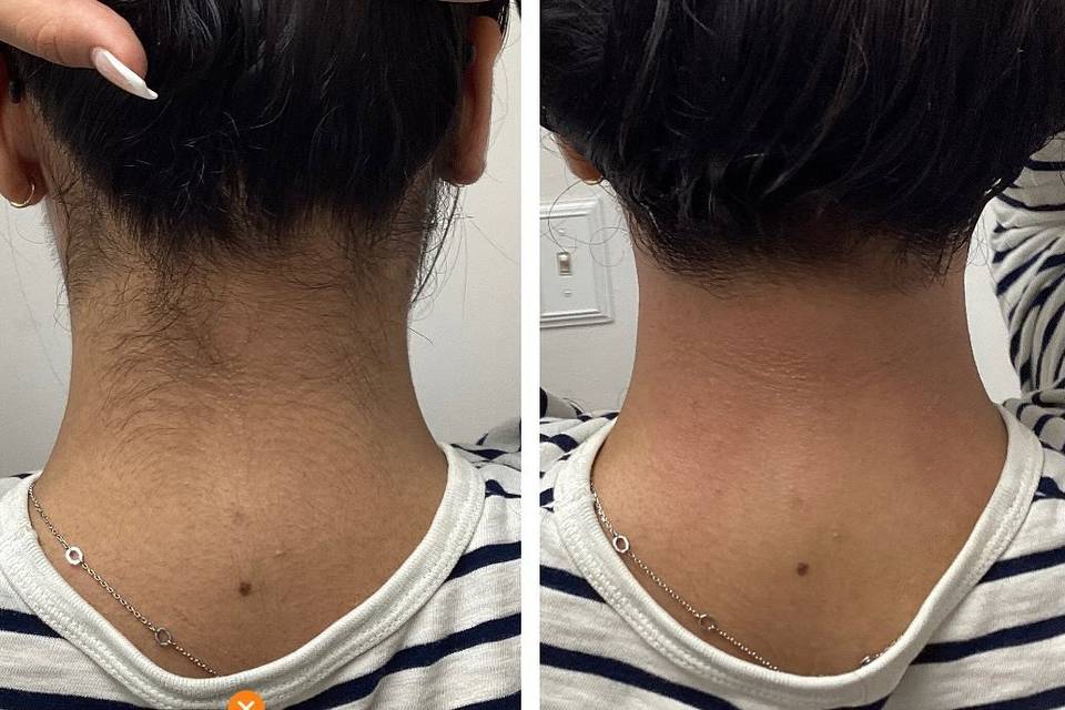 Laser Bar and Spa