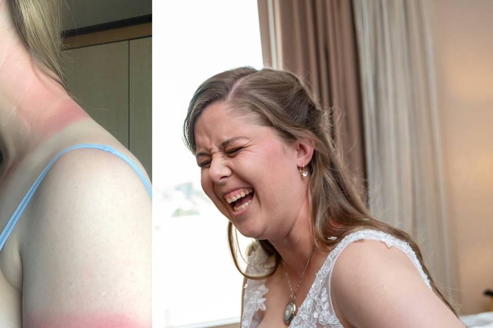 Covering a sunburn on bride