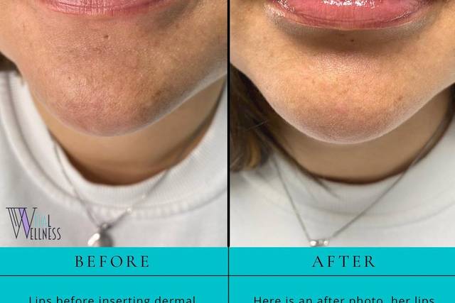 Lip Filler Before & After