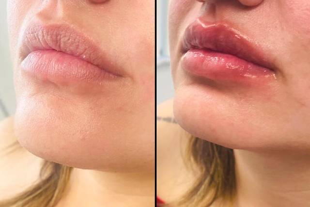 Lip Filler: Before and After