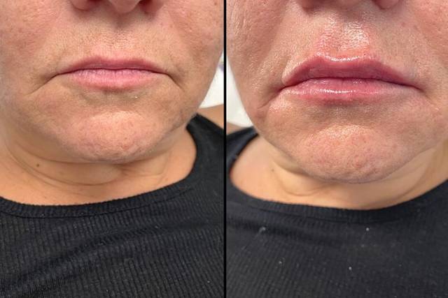 Lip Filler Before & After