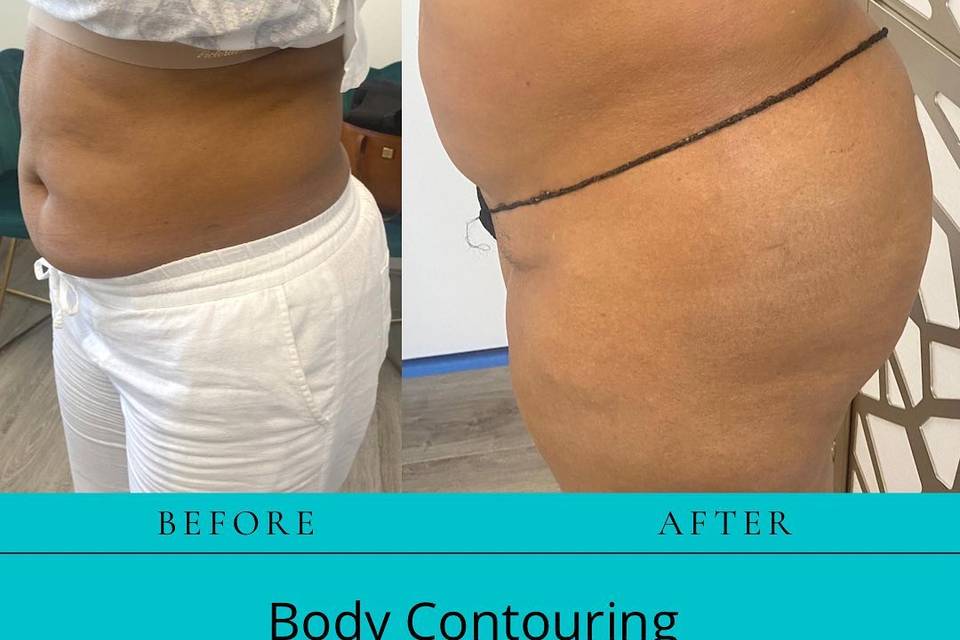 Body Contouring: Results