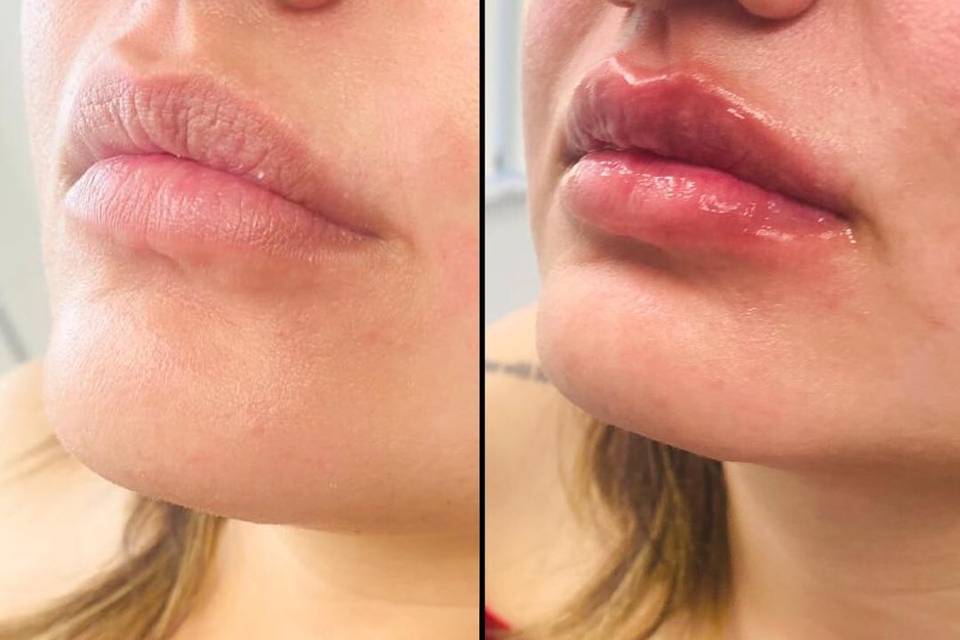 Lip Filler: Before and After