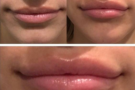 Increase lip size
