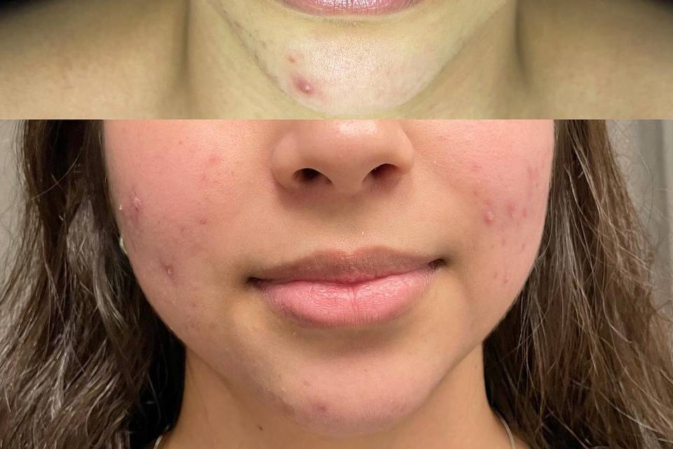 Acne progress